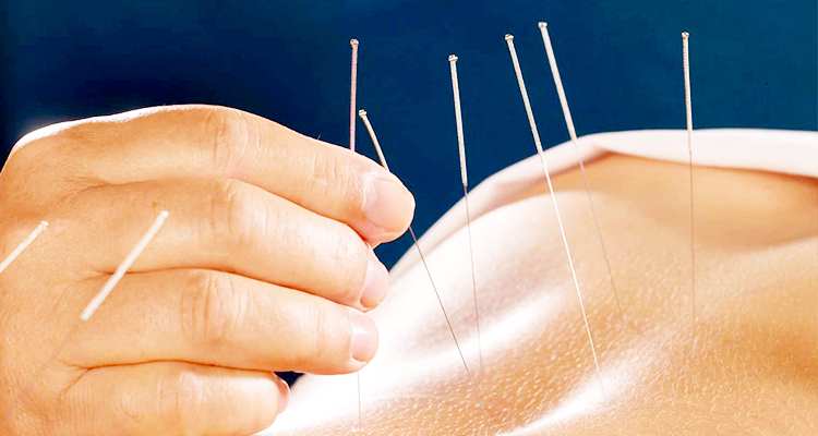 acupuncture