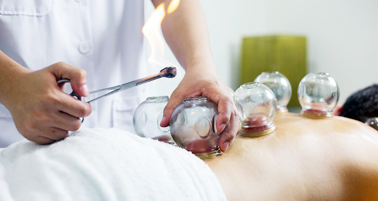 cupping